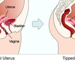 Tilted uterus sex hacks