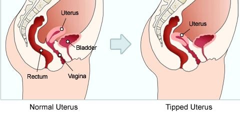 Tiled uterus