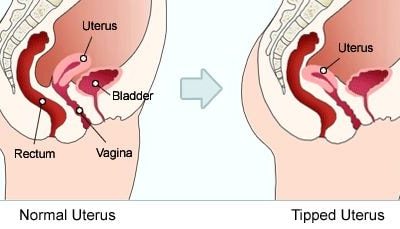 Tilted uterus sex hacks